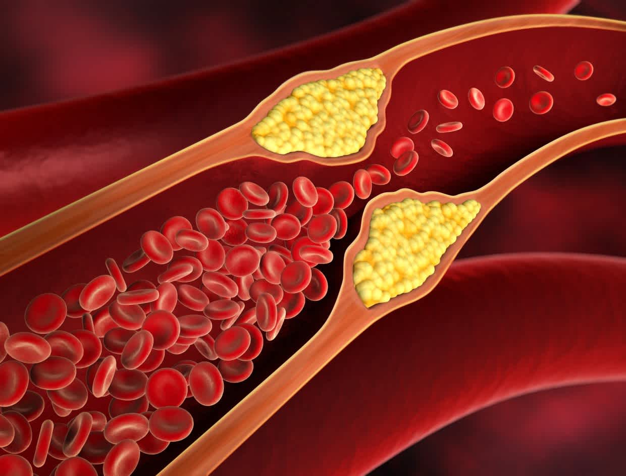 Bempedoic Acid Reduces Cardiovascular Events in Statin-Intolerant Patients: The CLEAR Outcomes Trial