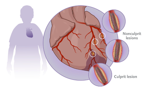 Physiology-Guided Complete Revascularization in Older Patients with Myocardial Infarction: The FIRE Trial