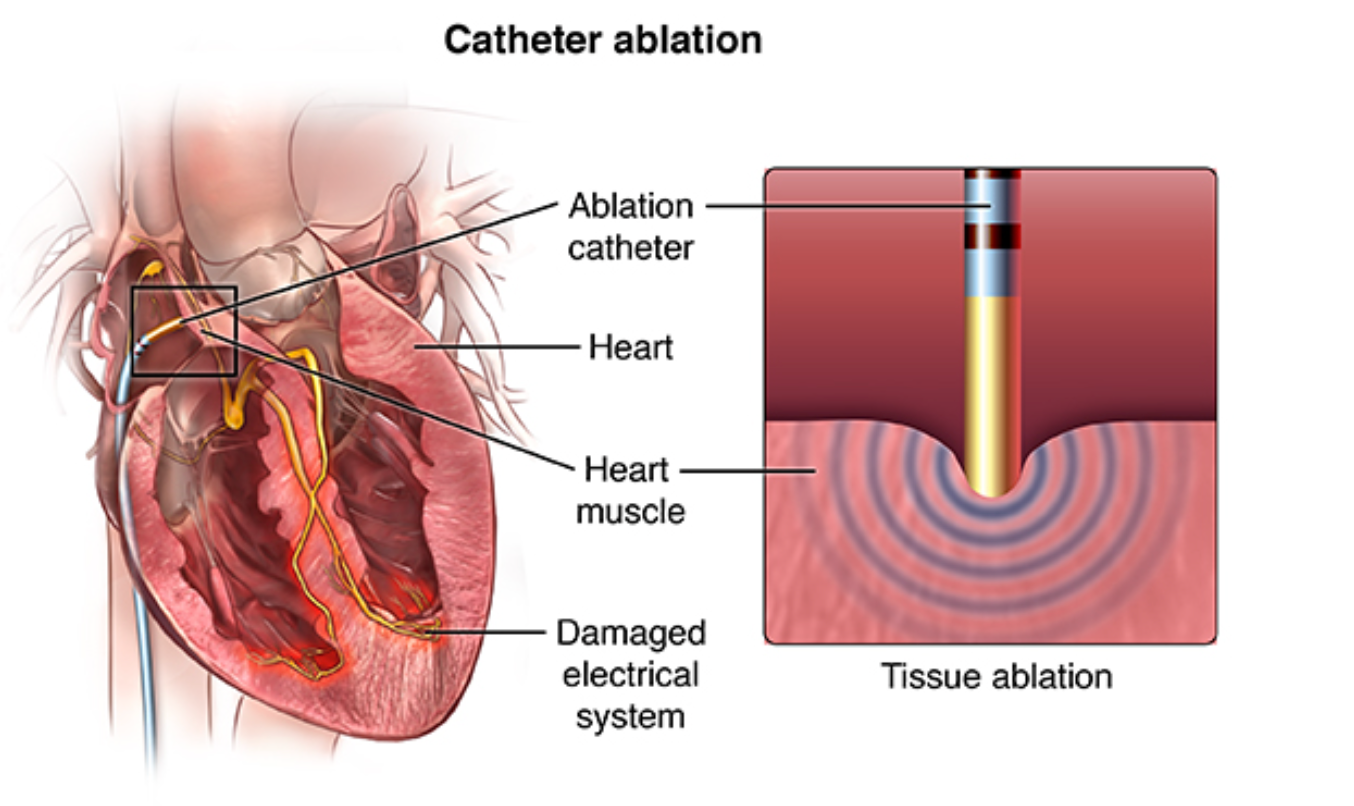 Catheter Ablation in End-Stage Heart Failure: A Game Changer for Patient Outcomes